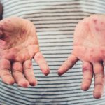 Waspada Darurat Campak Jelang Lebaran, Ikuti Tips dan Trik Berikut Ini!