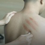 Kerokan Jadi Obat Sakit Simpel dan Sering Jadi Obat Andalan