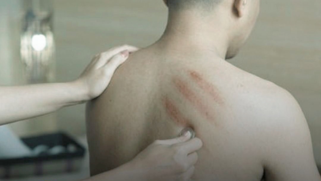 Kerokan Jadi Obat Sakit Simpel dan Sering Jadi Obat Andalan